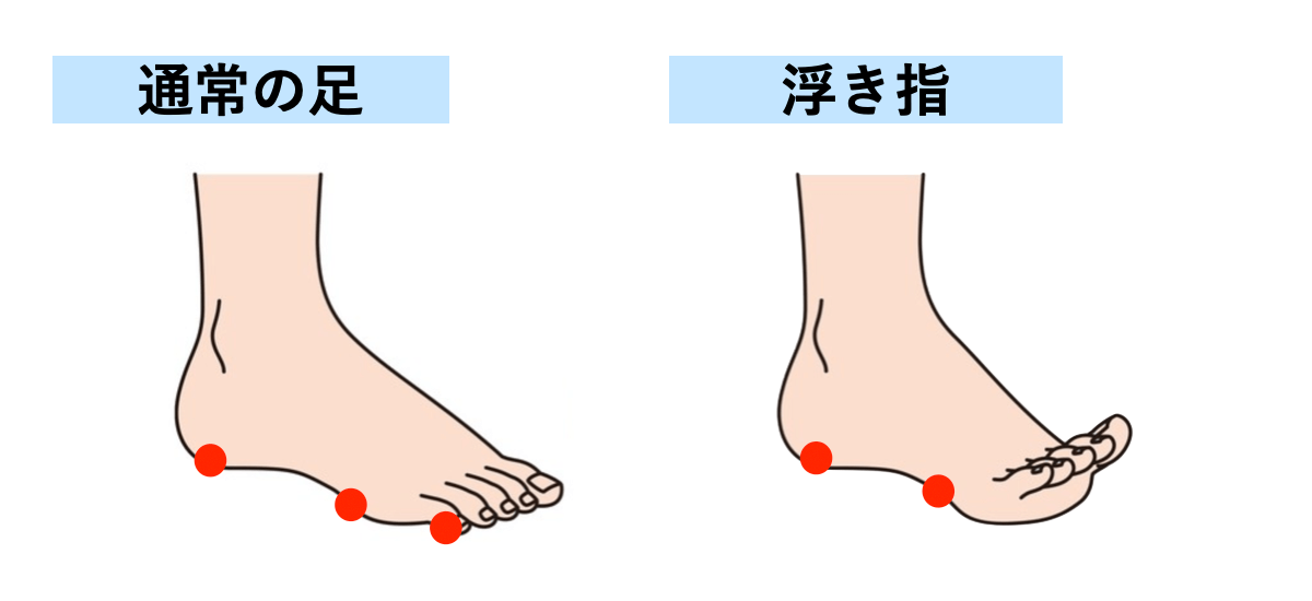 反り腰が改善しない原因は浮き指 女性の80 テツログ ダイエット完全攻略