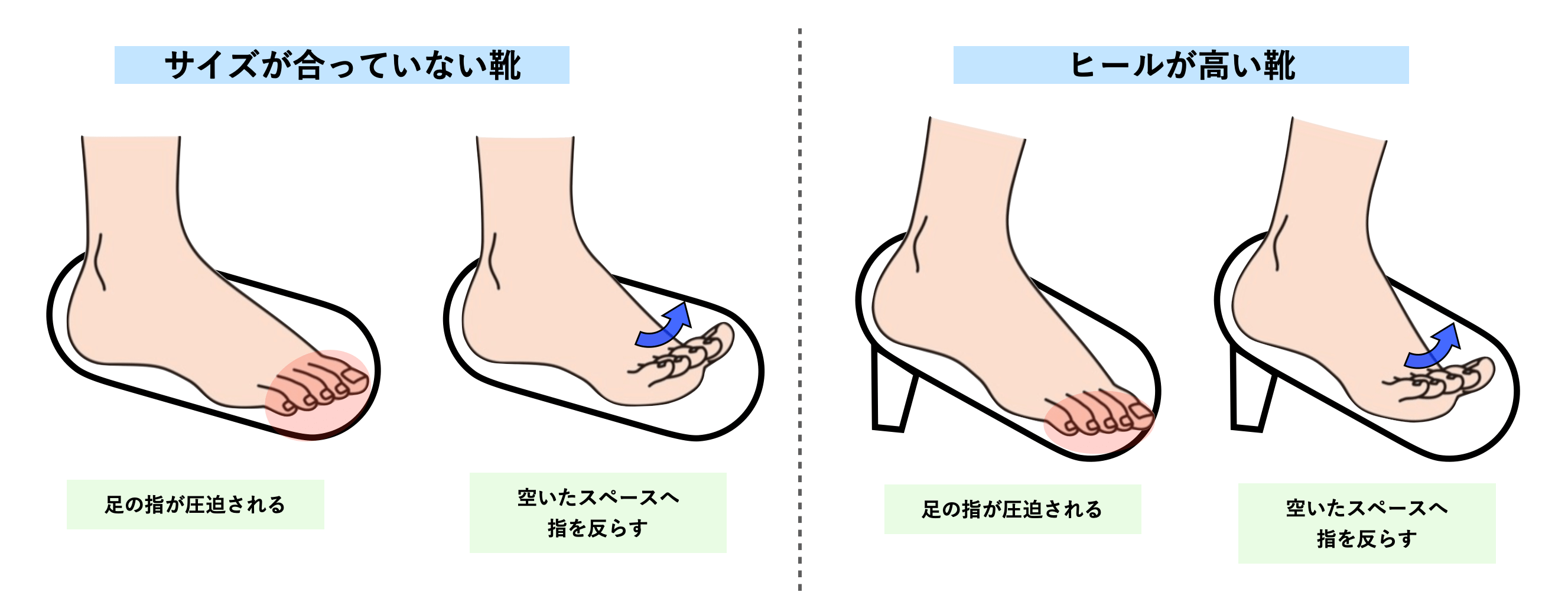 浮き指が反り腰の原因だった 浮き指を改善して下半身太りを解消 女性の80 が浮き指 テツログ ダイエット完全攻略