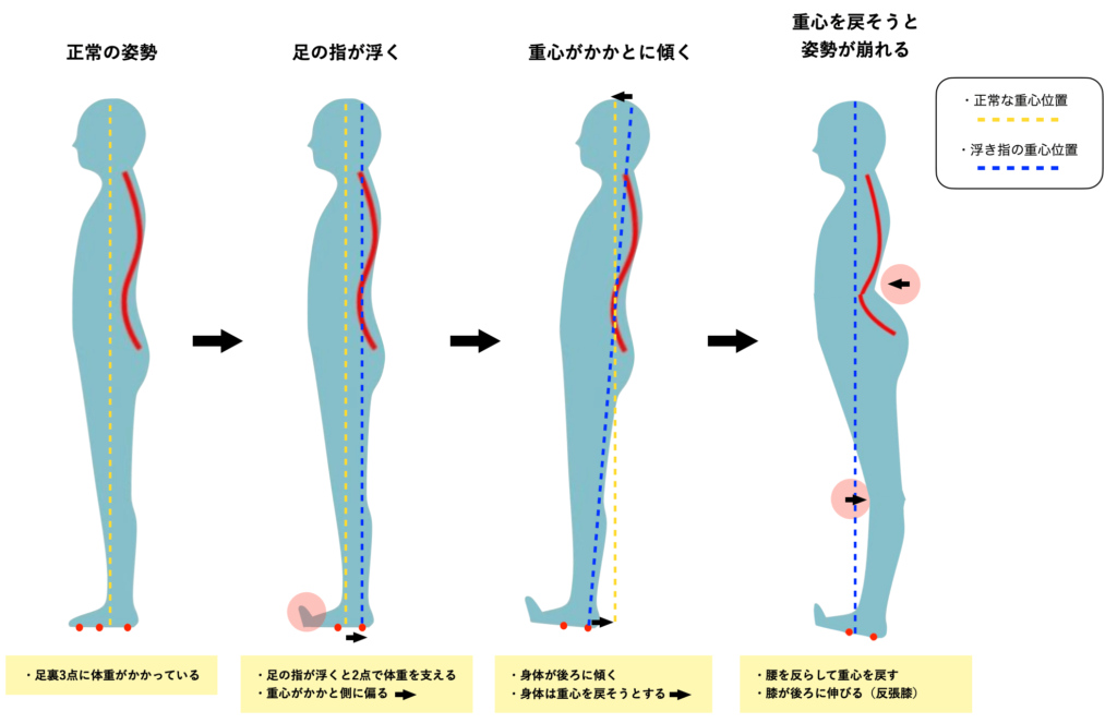 浮き指と反り腰の関係