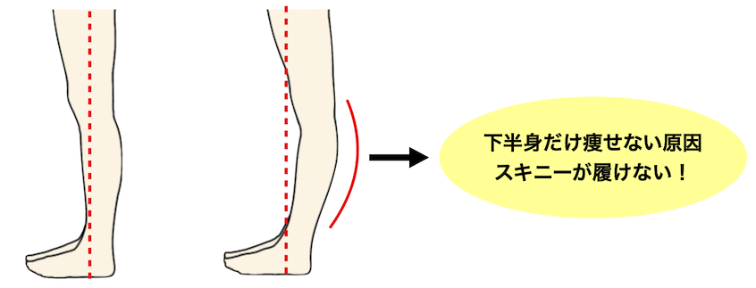 膝 原因 張 反 反張膝の原因は？反張膝の改善はバイオメカサポーター♪