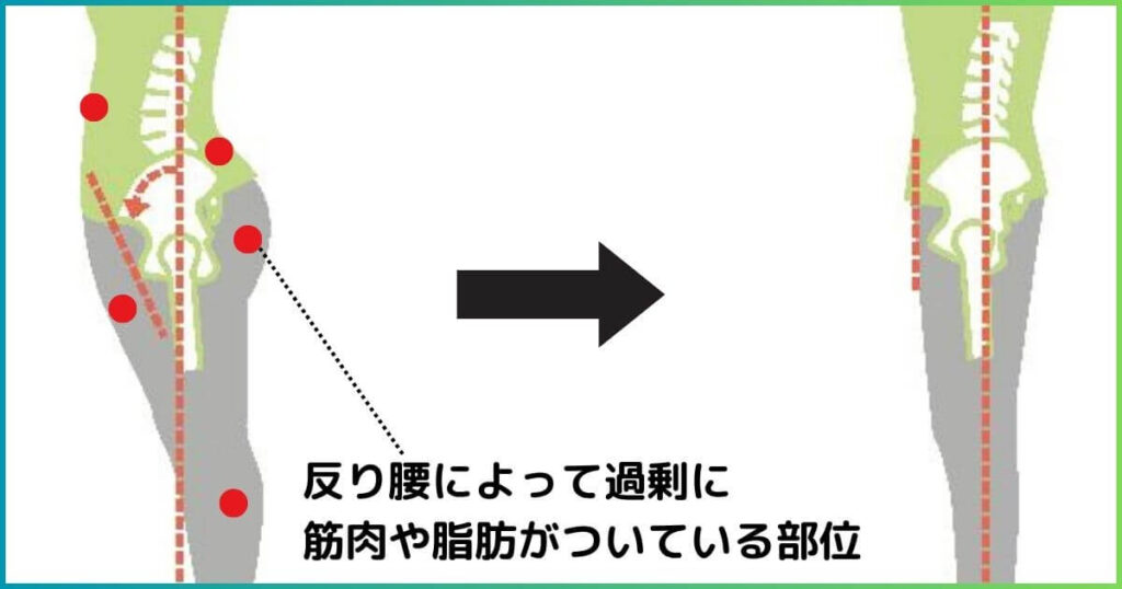 反り腰を改善すると下半身が細くなる理由