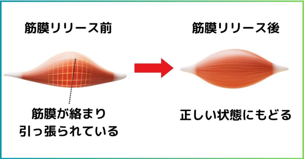 筋膜リリースとは