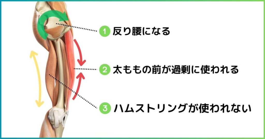 反り腰と太ももの筋肉の関係