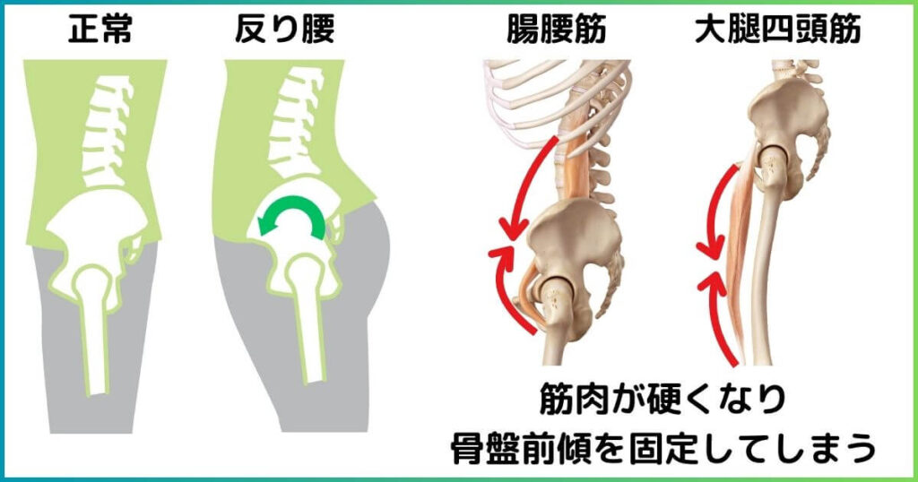 反り腰とは