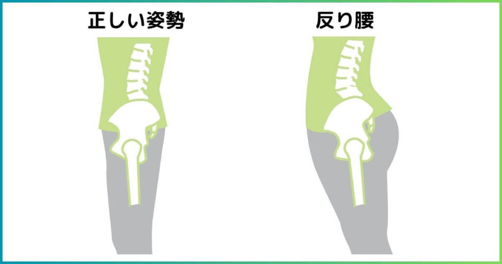 反り腰と正しい姿勢の比較