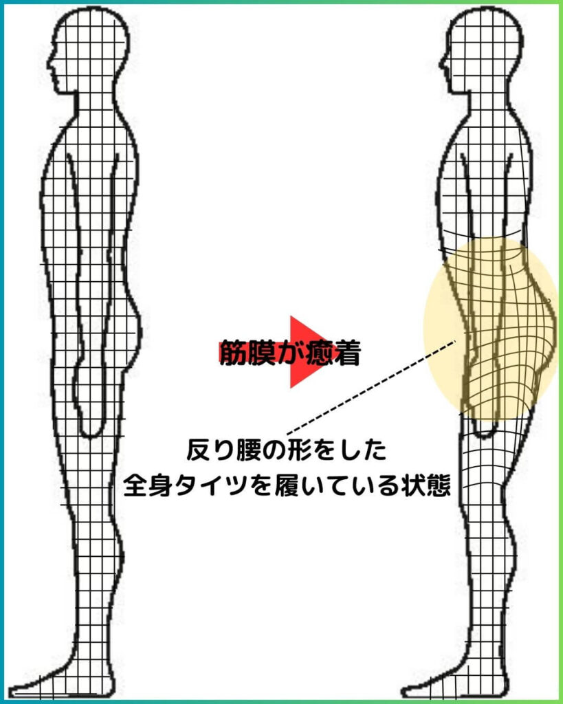 筋膜が癒着している 歪んだ全身タイツ