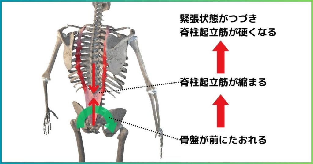 脊柱起立筋と反り腰の関係