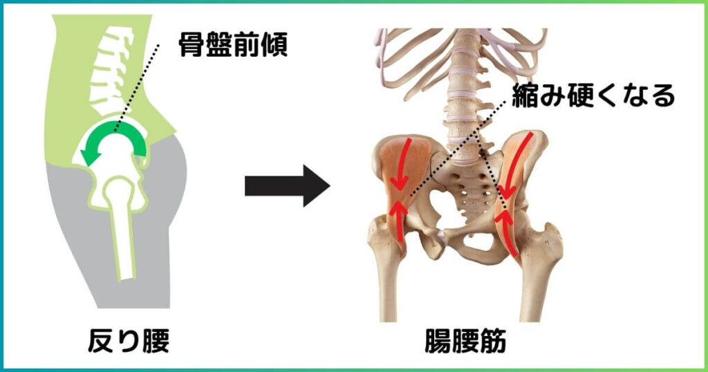 腸腰筋と反り腰の関係