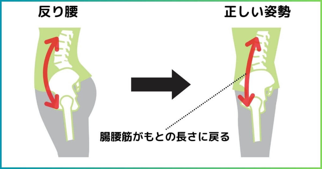 腸腰筋の長さと反り腰の関係