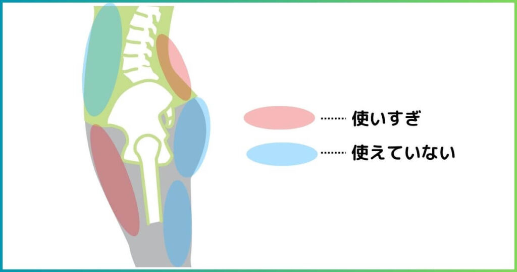 反り腰の原因となる筋肉の場所