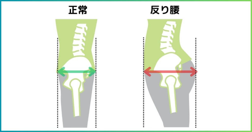 反り腰になると下半身が太くなる理由
