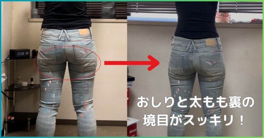 反り腰改善のビフォーアフター