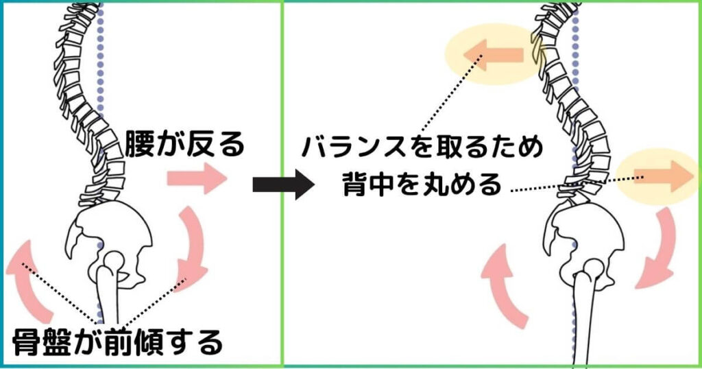 反り腰と猫背の関係